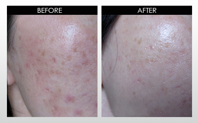Box scars and sun-induced hyperpigmentation Before and After