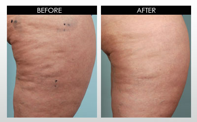 cellulite-before-and-after-2.jpg