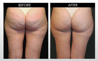 cellulite-before-and-after.jpg