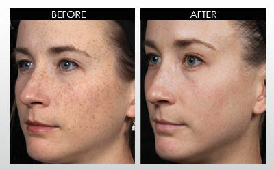 hyperpigmentation-before-and-after-2.jpg