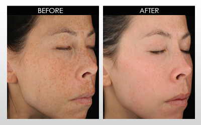 hyperpigmentation-before-and-after.jpg