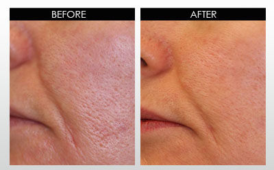 large-pores-before-and-after-2.jpg