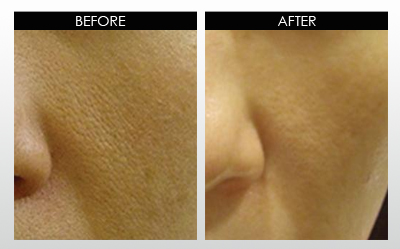 large-pores-before-and-after.jpg
