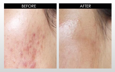 Moderate case hypertrophic acne scars results