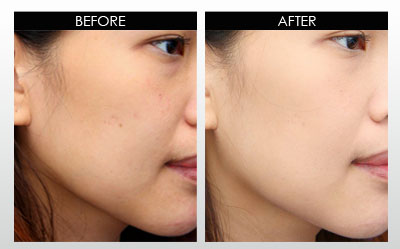 Derma Roller Before and After