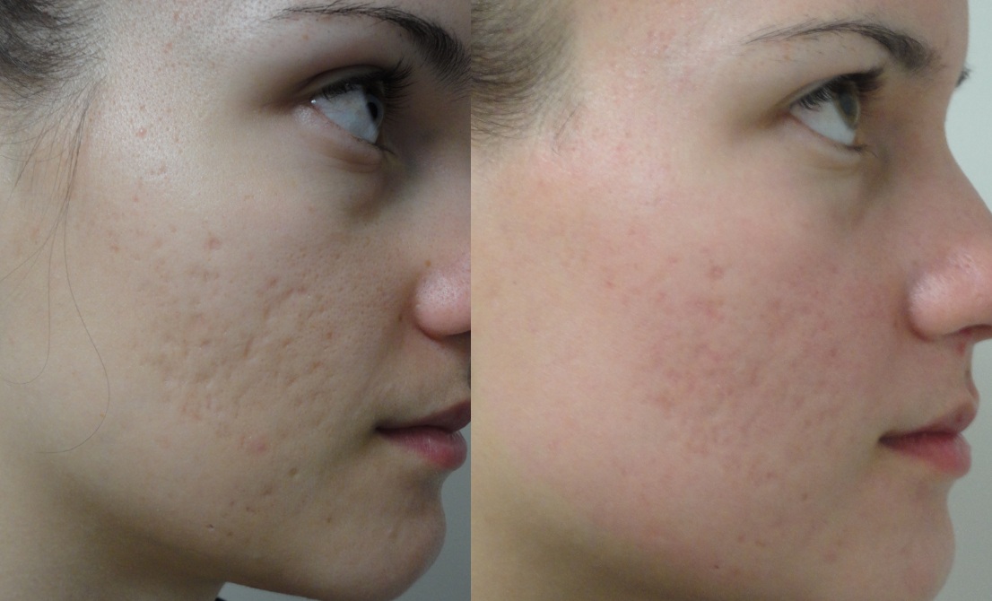 acne-fractional-co2-resurfacing-2weeks-after2.jpg