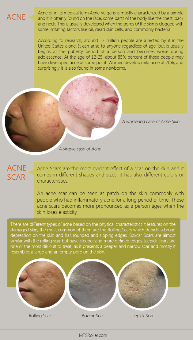 acne-scar-inforgraphics-mtsroller