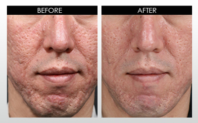 Ice pick acne scars before and after