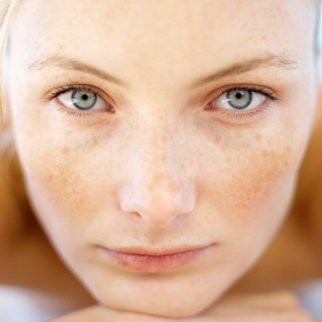 Melasma Natural Treatment