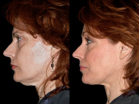 thermage1-before-and-after.jpg