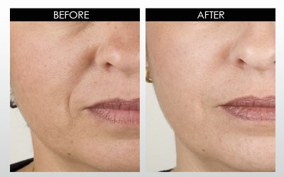 whitening-before-and-after-2.jpg