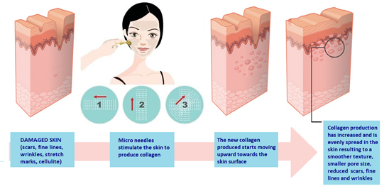 How to Use Derma Roller How to Use Derma Roller